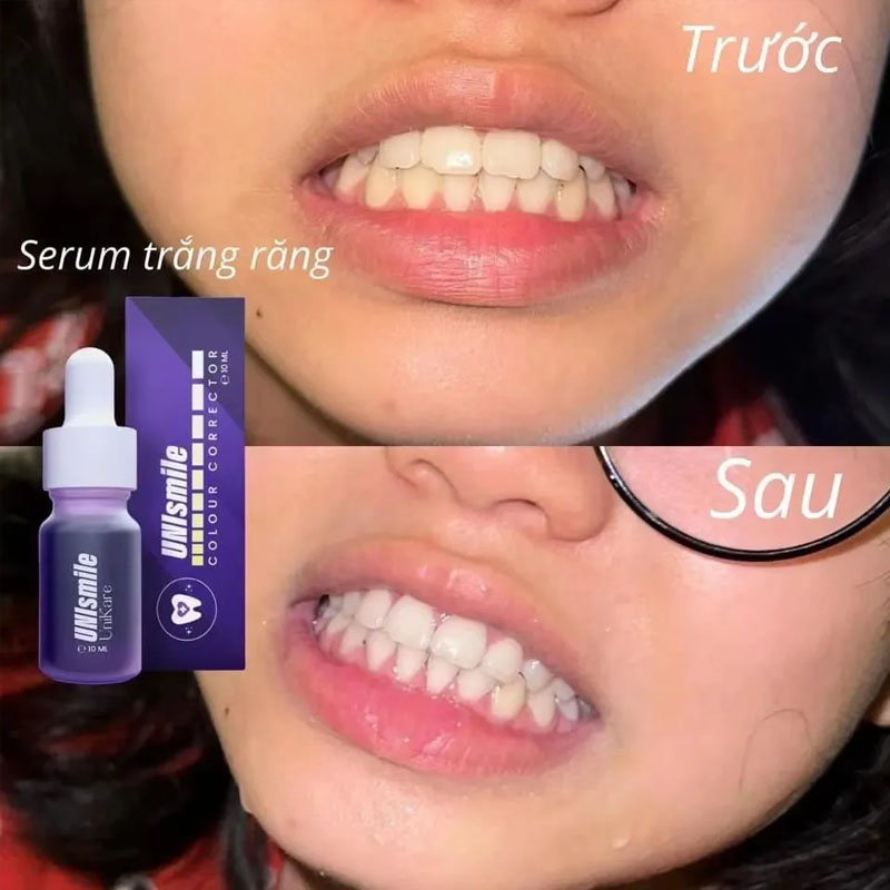 Esencja wybielająca do zębów U – Teeth Whitening Essence recenzja i cena