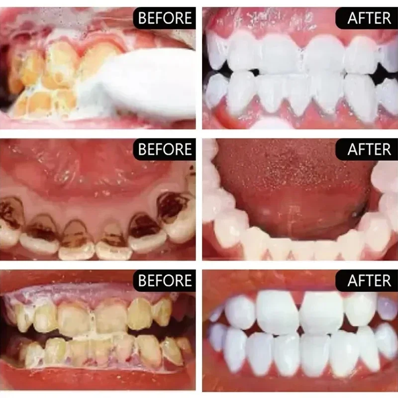 Szybkie usuwanie plam z dymu P – Teeth Whitening Fast recenzja i cena