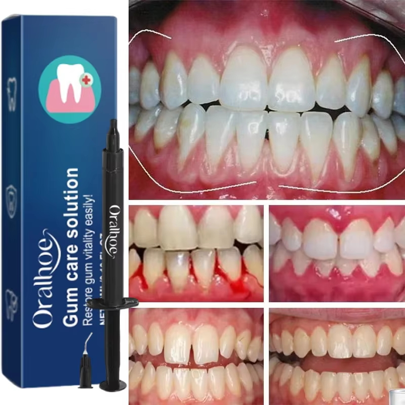 Żel do wybielania zębów, pielę – Teeth Whitening Gels recenzja i cena