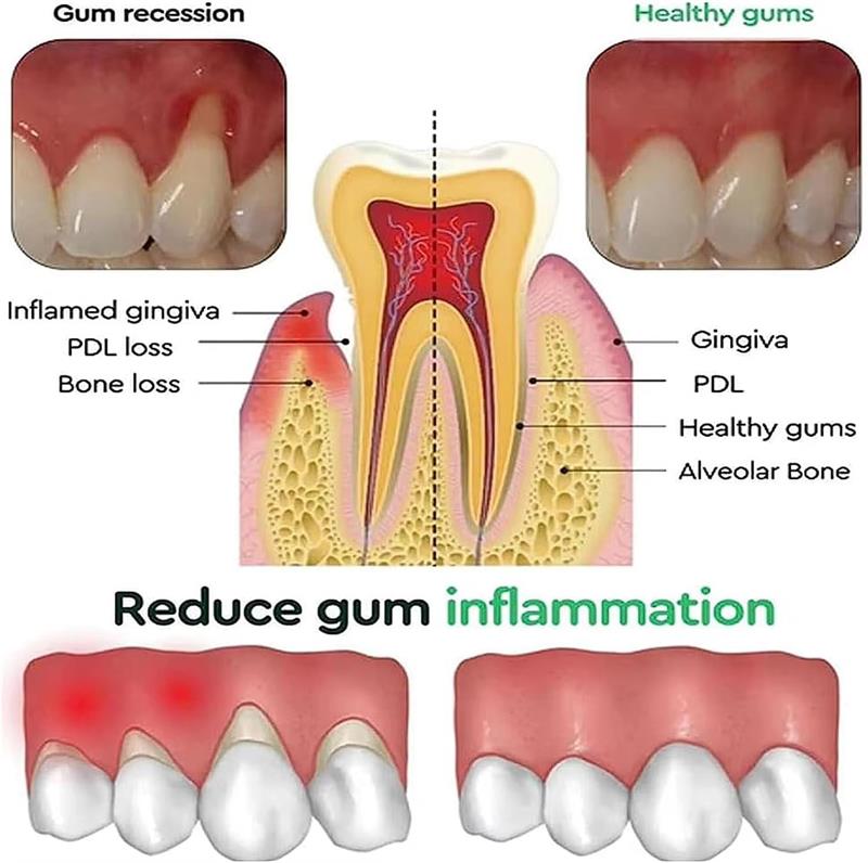 Żel do wybielania zębów, pielę – Teeth Whitening Gels recenzja i cena